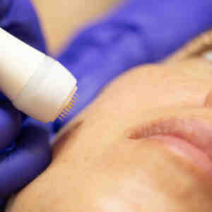 Radiofrecuencia Fraccionada Facial + Vitaminas Faciales
