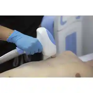 Depilacion Laser Hombre