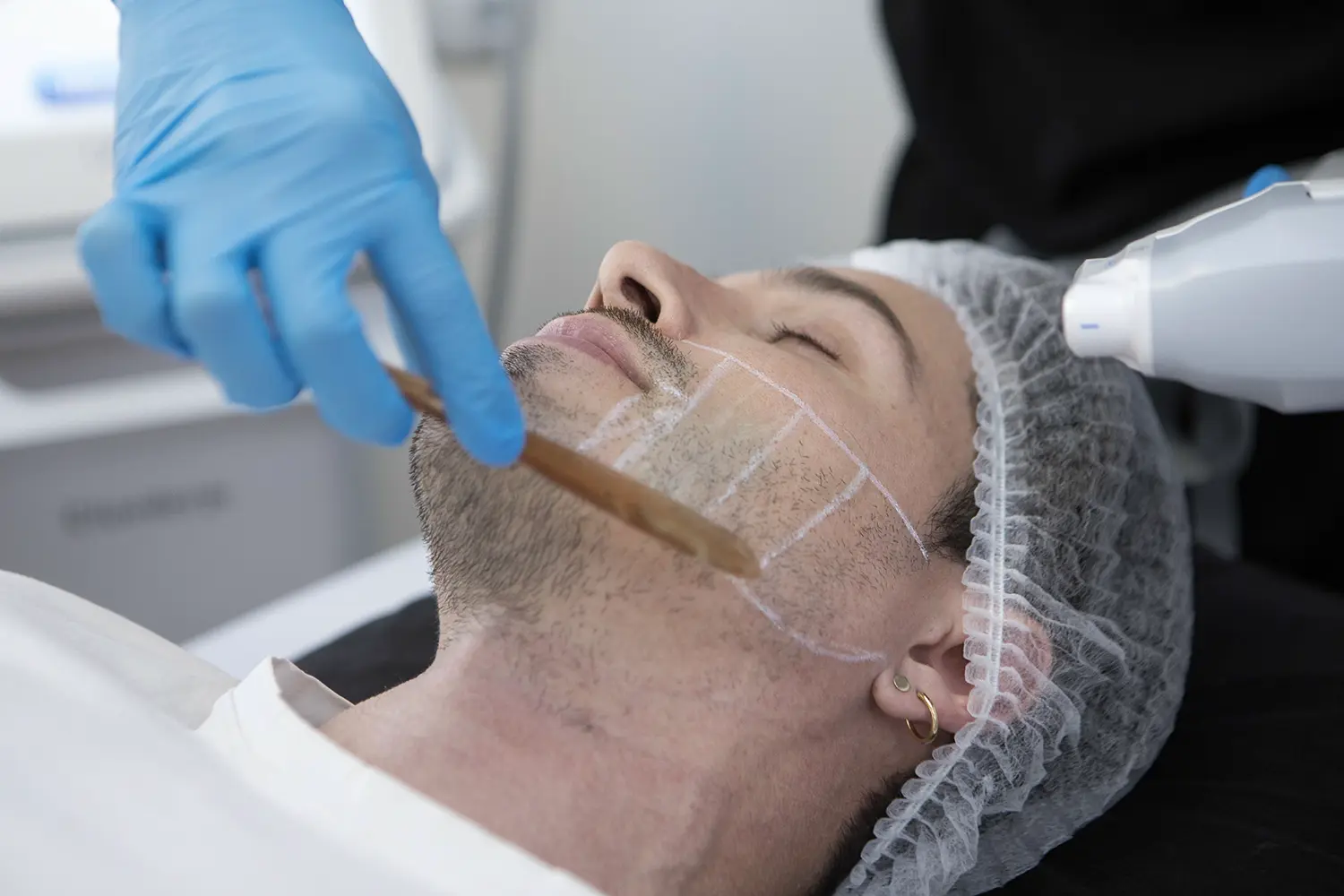 Hifu Facial