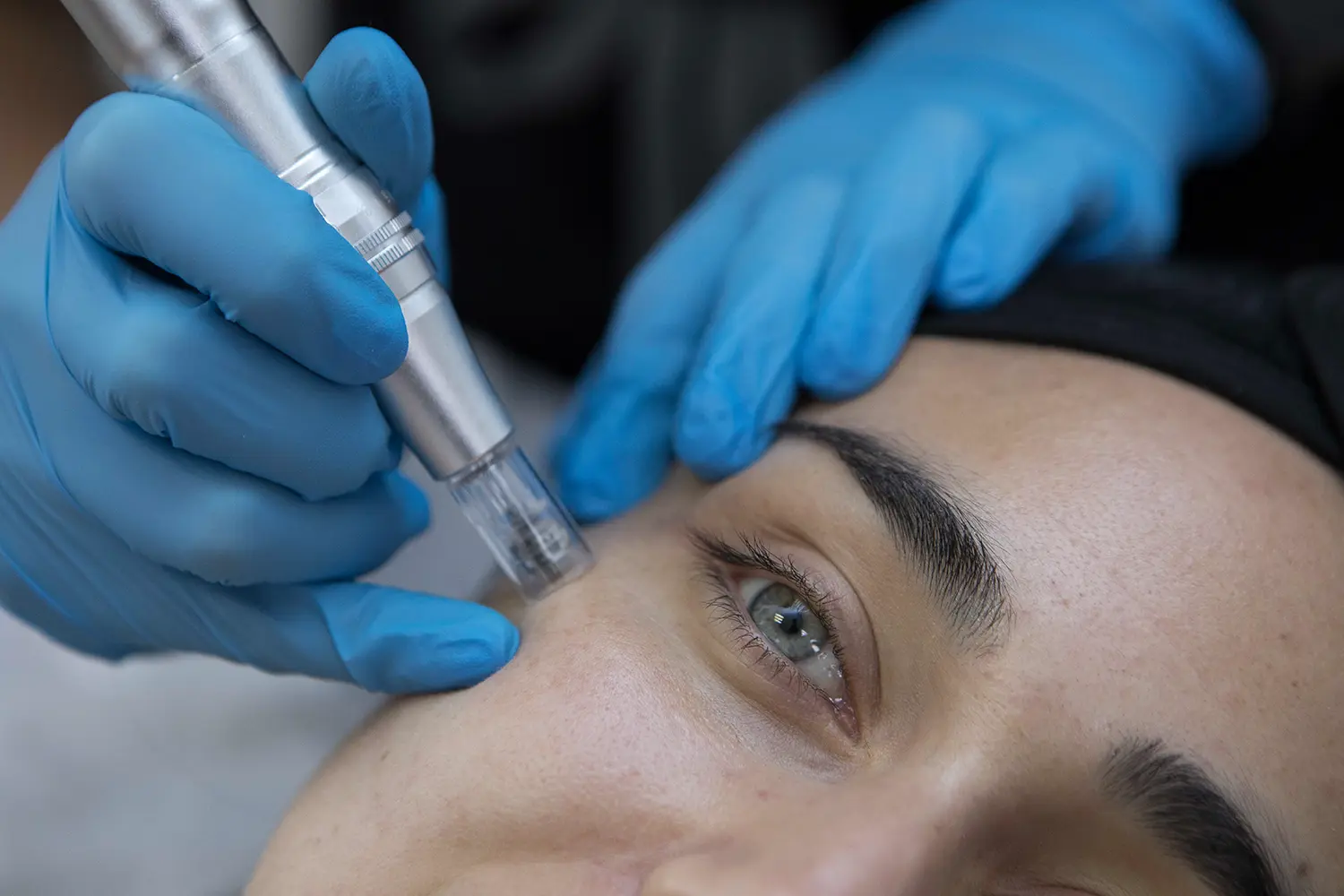 Tratamiento Para La Flacidez Facial 3 Flacidez Facial