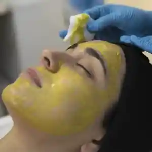 Peeling Químico 