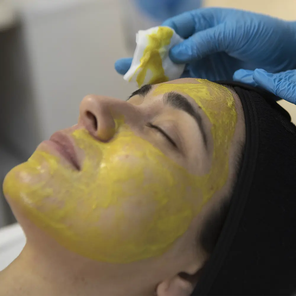 Peeling Químico 