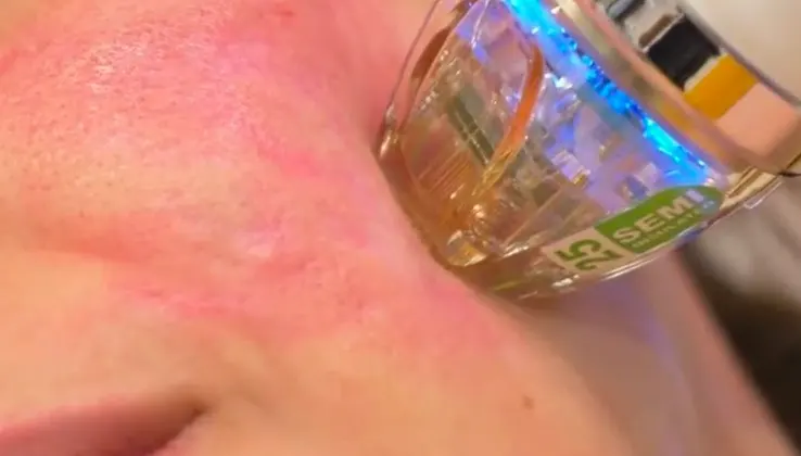 Radiofrecuencia Fraccionada Facial + Vitaminas Faciales