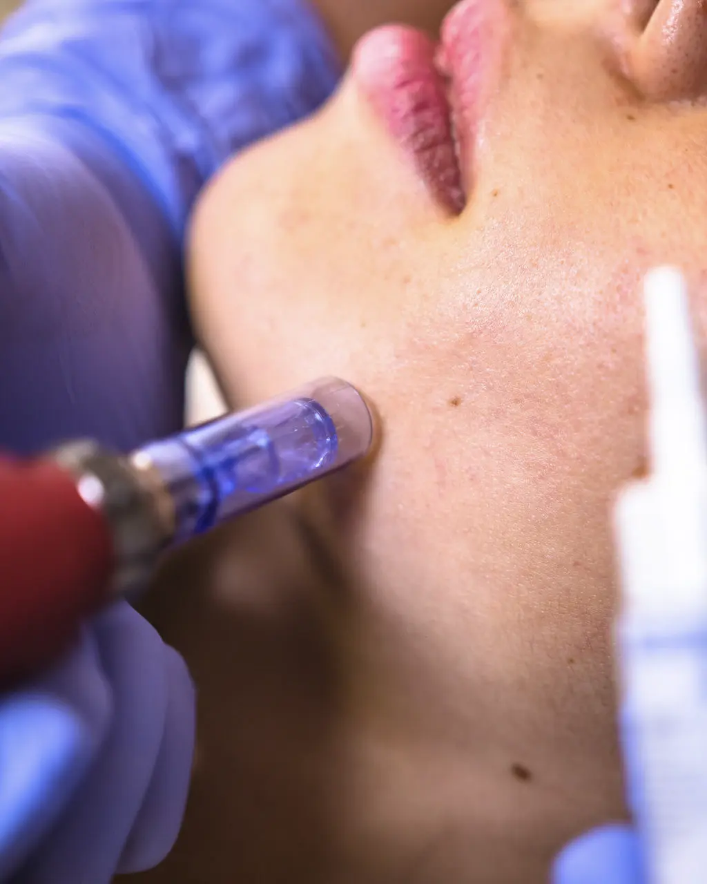 Tratamiento Hidratacion Facial 3 Hidratacion Facial