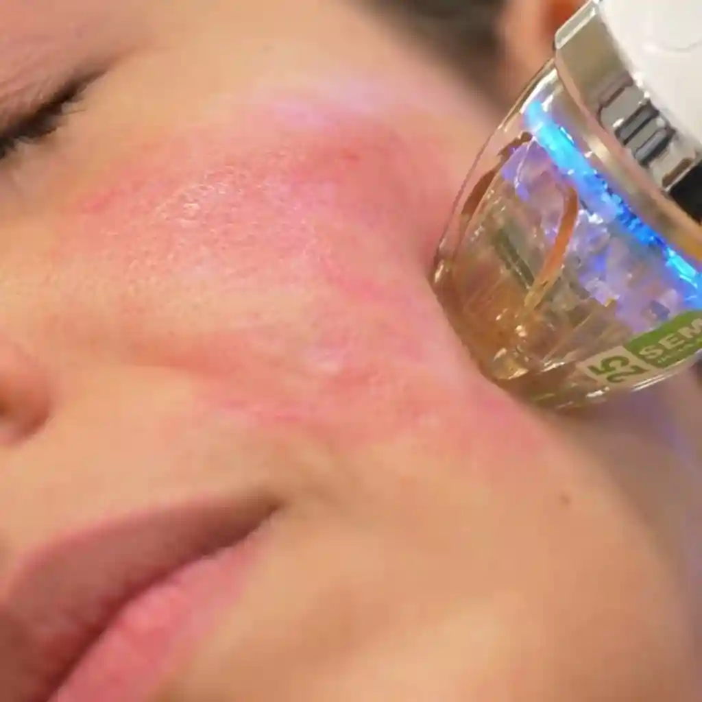 Radiofrecuencia Fraccionada Facial