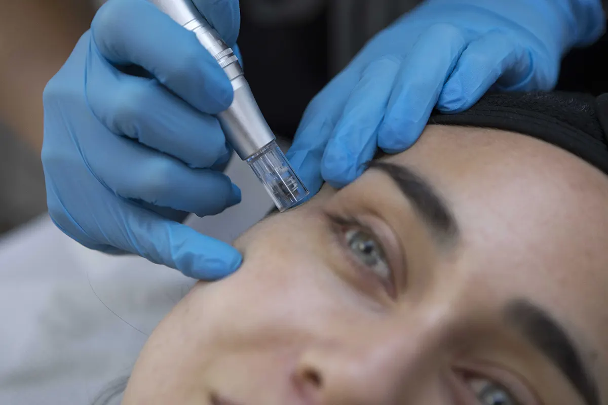 Tratamiento De Ojeras