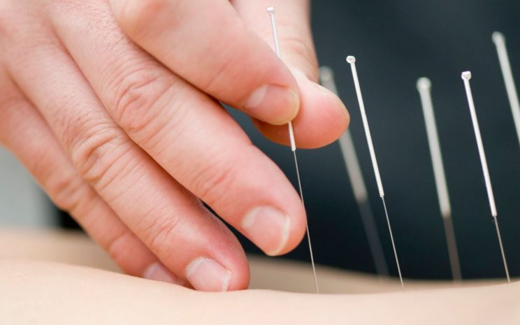 Acupuntura