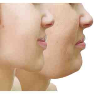 Evaluación Criolift - Armonización Facial
