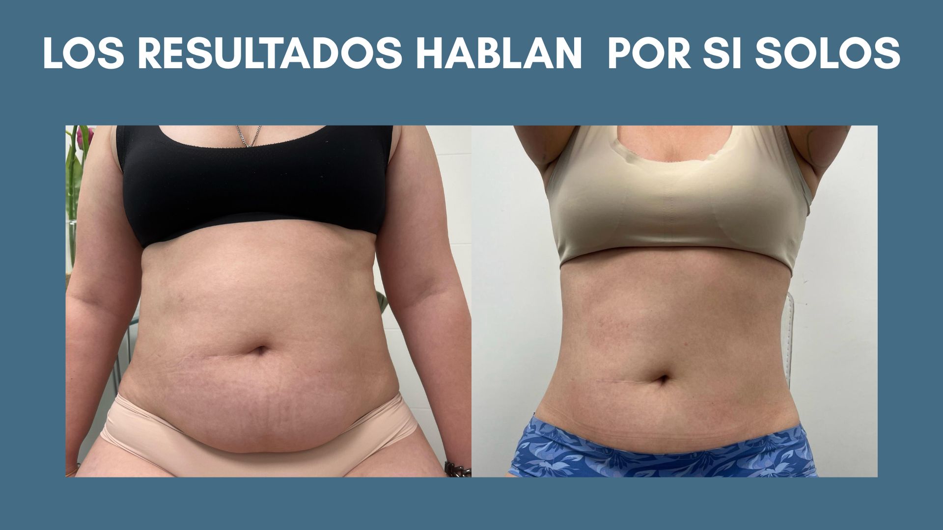 Ultracool Lipo: El Tratamiento Para Grasa Localizada Que Está Revolucionando El Mundo De La Estética 1 Ultracool Lipo: El Tratamiento Para Grasa Localizada Que Está Revolucionando El Mundo De La Estética - Centro De Estetica Integral En Las Condes
