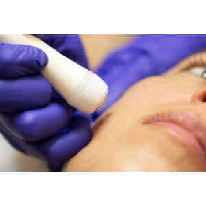 Radiofrecuencia Fraccionada Facial Con Exosomas