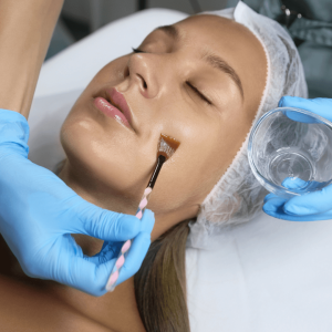 Tratamientos 12 Peeling Químico Facial