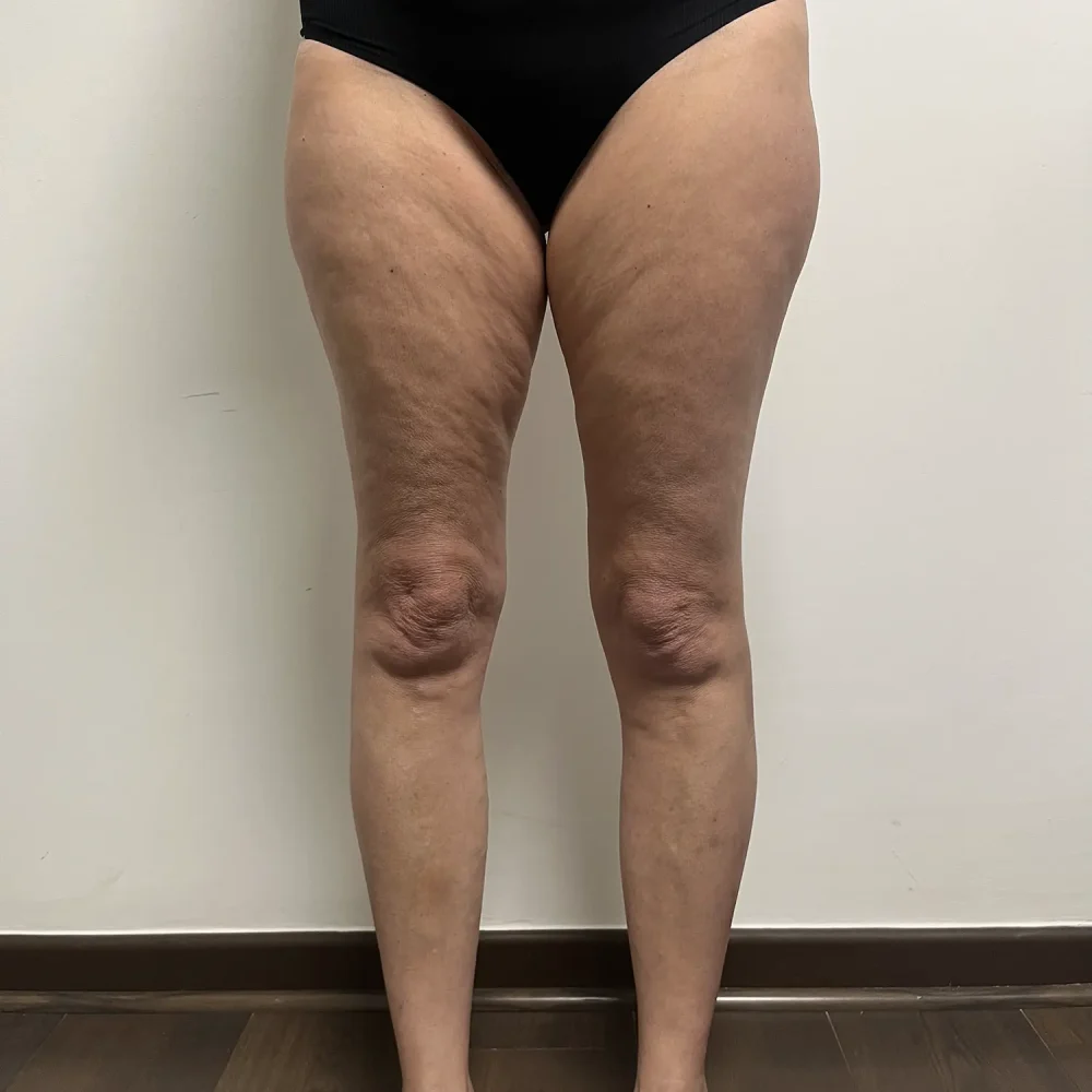 Tratamiento Flacidez Corporal